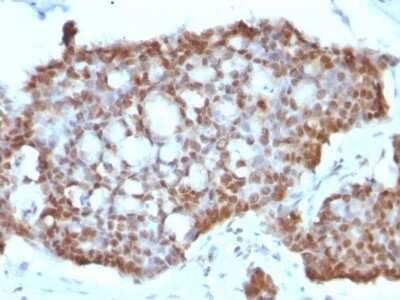 Immunohistochemistry-Paraffin: ER beta/NR3A2 Antibody (ERb455) - Azide and BSA Free [NBP2-33066] - Formalin-fixed, paraffin-embedded human Gastric Carcinoma stained with ER beta/NR3A2 Antibody (ERb455).