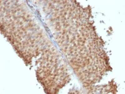 Immunohistochemistry-Paraffin: ER beta/NR3A2 Antibody (ERb455) - Azide and BSA Free [NBP2-33066] - Formalin-fixed, paraffin-embedded human Bladder Carcinoma stained with ER beta/NR3A2 Antibody (ERb455).