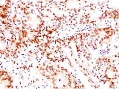 Immunohistochemistry-Paraffin: ER beta/NR3A2 Antibody (ERb455) - Azide and BSA Free [NBP2-33066] - Formalin-fixed, paraffin-embedded human Ovarian Carcinoma stained with ER beta/NR3A2 Antibody (ERb455).