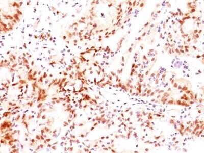 Immunohistochemistry-Paraffin: ER beta/NR3A2 Antibody (ERb455) - Azide and BSA Free [NBP2-33066] - Formalin-paraffin ovarian cancer stained with Estrogen receptor beta Ab (ERb455).