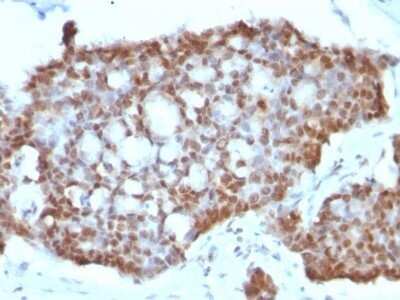 Immunohistochemistry-Paraffin: ER beta/NR3A2 Antibody (ERb455) - IHC-Prediluted [NBP2-44365] - Formalin-fixed, paraffin-embedded human Gastric Carcinoma stained with ER beta/NR3A2 Antibody (ERb455).