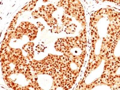 Immunohistochemistry-Paraffin: ER beta/NR3A2 Antibody (ERb455) - IHC-Prediluted [NBP2-44365] - Formalin paraffin breast cancer stained with Estrogen receptor beta Ab (ERb455).