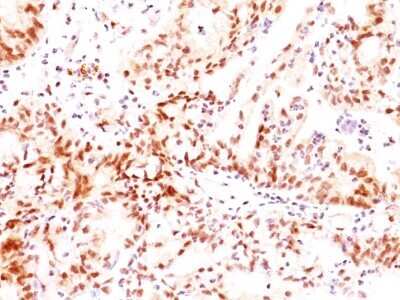 Immunohistochemistry-Paraffin: ER beta/NR3A2 Antibody (ERb455) - IHC-Prediluted [NBP2-44365] - Immunohistochemistry-Paraffin: ER beta/NR3A2 Antibody (ERb455) [NBP2-29439] - Formalin-paraffin ovarian cancer stained with Estrogen receptor beta Ab (ERb455).