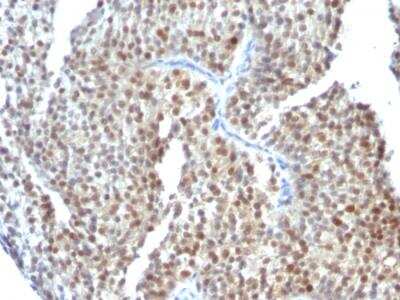 Immunohistochemistry-Paraffin: ER beta/NR3A2 Antibody (ESR2/686) - IHC-Prediluted [NBP2-48309] - Formalin-fixed, paraffin-embedded human Bladder Carcinoma stained with ER-beta Mouse Monoclonal Antibody (ESR2/686)