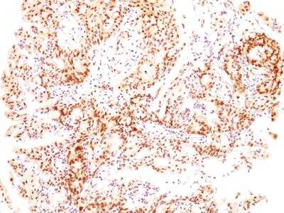 Immunohistochemistry-Paraffin: ER beta/NR3A2 Antibody (ESR2/686) - IHC-Prediluted [NBP2-48309] - Formalin-fixed, paraffin-embedded human Ovarian Carcinoma stained with ER-beta Mouse Monoclonal Antibody (ESR2/686).