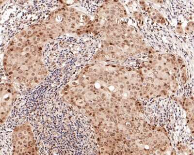 Immunohistochemistry-Paraffin: ER beta/NR3A2 Antibody (JJ09-02) [NBP2-67894] - Analysis of paraffin-embedded human breast carcinoma tissue with Rabbit anti-ER beta/NR3A2 antibody washed with ddH2O and PBS, and then probed with the primary antibody at 1/150 dilution for 1 hour at room temperature. The detection was performed using an HRP conjugated compact polymer system. DAB was used as the chromogen. Tissues were counterstained with hematoxylin and mounted with DPX.