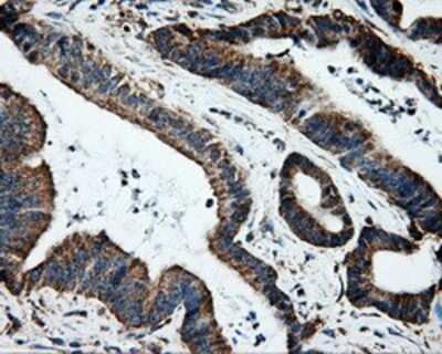 Immunohistochemistry: ERAB Antibody (OTI10B4) - Azide and BSA Free [NBP2-70871] - Staining of paraffin-embedded Adenocarcinoma of colon tissue using anti-ERAB mouse monoclonal antibody.