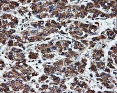 Immunohistochemistry: ERAB Antibody (OTI10B4) - Azide and BSA Free [NBP2-70871] - Staining of paraffin-embedded Carcinoma of liver tissue using anti-ERAB mouse monoclonal antibody.