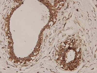 Immunohistochemistry-Paraffin: ERAS Antibody (D10-B9) [NBP2-66822] - Analysis of paraffin-embedded human breast carcinoma tissue using anti- ERAS Mouse mAb.