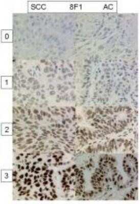 Immunohistochemistry: ERCC1 Antibody (8F1) - Azide and BSA Free [NBP2-80725] - Analysis of ERCC1 in human non-small cell lung cancer. Image courtesy of product review submitted by Alex Soltermann. Image from the standard format of this antibody.