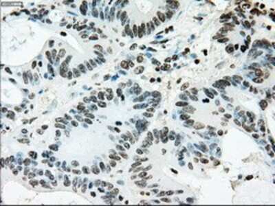 Immunohistochemistry: ERCC1 Antibody (OTI1A3) - Azide and BSA Free [NBP2-70662] - Staining of paraffin-embedded Adenocarcinoma of colon tissue using anti-ERCC1 mouse monoclonal antibody.