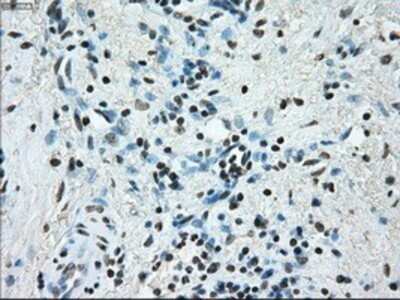 Immunohistochemistry: ERCC1 Antibody (OTI1A3) - Azide and BSA Free [NBP2-70662] - Staining of paraffin-embedded Adenocarcinoma of endometrium tissue using anti-ERCC1 mouse monoclonal antibody.