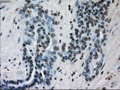 Immunohistochemistry: ERCC1 Antibody (OTI1A3) - Azide and BSA Free [NBP2-70662] - Staining of paraffin-embedded Adenocarcinoma of ovary tissue using anti-ERCC1 mouse monoclonal antibody.