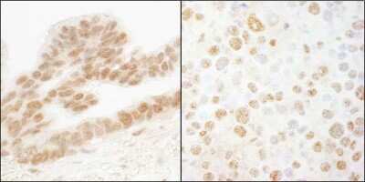 Immunohistochemistry-Paraffin: ERF Antibody [NB100-88120] - FFPE section of human ovarian carcinoma (left) and mouse renal cell carcinoma (right). Antibody: Affinity purified rabbit anti-ERF (NB100-88120). Detection: DAB