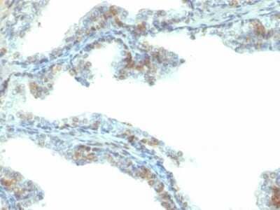 Immunohistochemistry-Paraffin: ERG Antibody (ERG/2107) [NBP3-08915] - Formalin-fixed, paraffin-embedded human prostate carcinoma stained with ERG Mouse Monoclonal Antibody (ERG/2107).