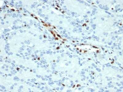 Immunohistochemistry-Paraffin: ERG Antibody (ERG/22R) - Azide and BSA Free [NBP3-08916] - Formalin-fixed, paraffin-embedded human prostate tissue stained with ERG Recombinant Rabbit Monoclonal Antibody (ERG/22R) at 1ug/ml. HIER: Tris/EDTA pH 9; 95C/45min. 2 Ab: HRP-Polymer:30mins; DAB:5min.