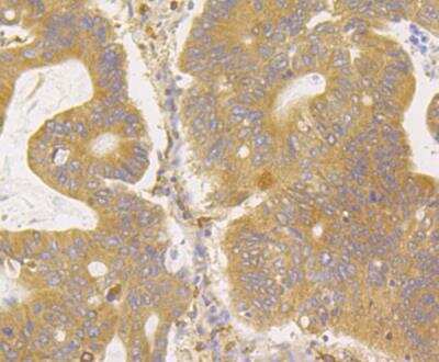 Immunohistochemistry: ERGI3 Antibody [NBP2-76928] - Immunohistochemical analysis of paraffin-embedded human colon cancer tissue using anti-ERGI3 antibody. Counter stained with hematoxylin.