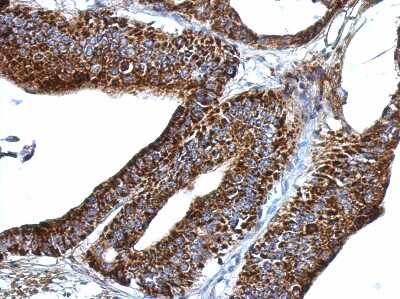 Immunohistochemistry-Paraffin: ERGI3 Antibody [NBP2-16367] - Immunohistochemical analysis of paraffin-embedded Gastric ca, using antibody at 1:500 dilution.