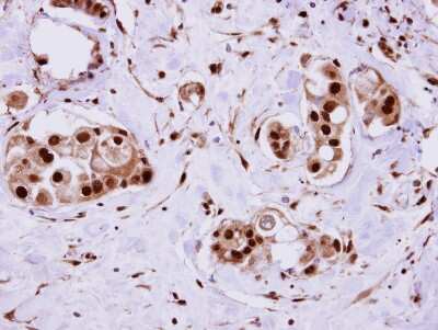 Immunohistochemistry-Paraffin: ERH Antibody [NBP1-32198] - Paraffin-embedded Breast Carcinoma; antibody dilution 1:500.