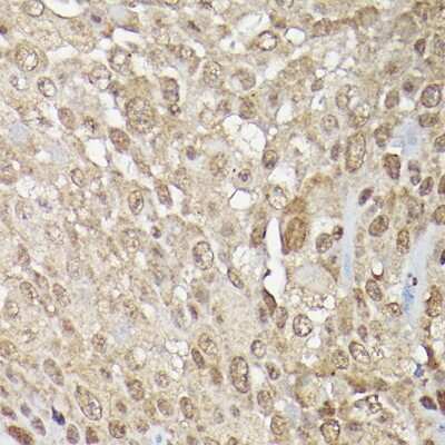 Immunohistochemistry-Paraffin: ERK1/2 Antibody [NBP3-05652] - Human urothelial carcinoma using ERK1/2 Rabbit pAb (NBP3-05652) at dilution of 1:200 (40x lens).