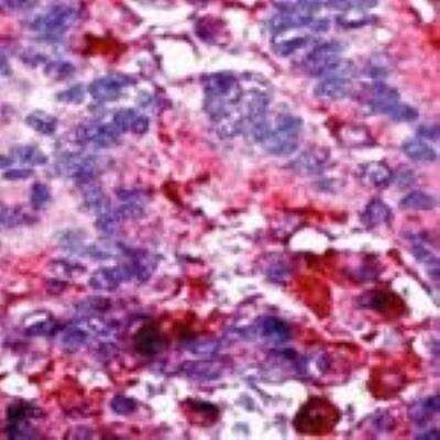 Immunohistochemistry-Paraffin: ERK1 Antibody [NBP2-26406] - IHC analysis of ERK1 formalin-fixed paraffin embedded human breast carcinoma using NBP2-26406.