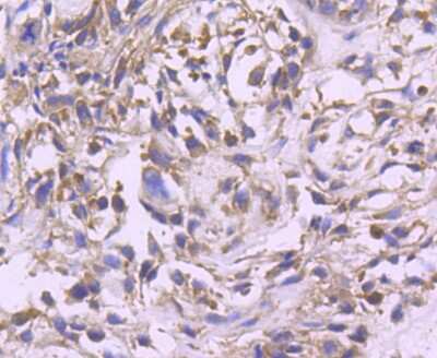 Immunohistochemistry-Paraffin: ERK2 Antibody (SZ25-01) [NBP2-67360] - Analysis of paraffin-embedded human breast carcinoma tissue using anti-ERK2 antibody. Counter stained with hematoxylin.