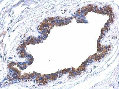 Immunohistochemistry-Paraffin: ERK4/MAPK4 Antibody [NBP1-31594] - Paraffin-embedded breast ca, using antibody at 1:500 dilution.