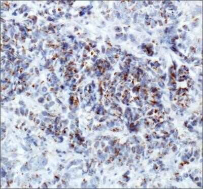 Immunohistochemistry: ERManI Antibody (3C2) - Azide and BSA Free [NBP2-80726] - IHC staining of ERManI in human breast cancer using DAB with hematoxylin counterstain. Image from the standard format of this antibody.