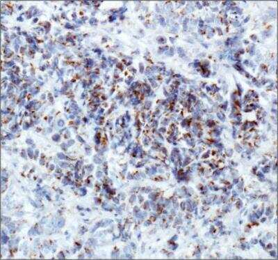 Immunohistochemistry: ERManI Antibody (3C2) [NBP2-13167] - IHC staining of ERManI in human breast cancer using DAB with hematoxylin counterstain.