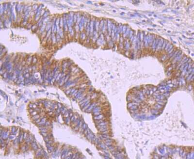 Immunohistochemistry-Paraffin: ERP29 Antibody (JG34-42) [NBP2-75483] - Analysis of paraffin-embedded human colon cancer tissue using anti-ERp29 antibody. Counter stained with hematoxylin.