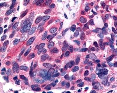 Immunohistochemistry-Paraffin: ERR beta/NR3B2 Antibody [NLS7131] - Analysis of anti-ESRRB / ERR Beta antibody with human lung, small cell carcinoma.