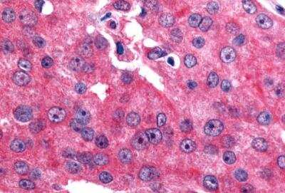 Immunohistochemistry-Paraffin: ERR beta/NR3B2 Antibody [NLS7131] - Prostate, Carcinoma