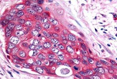 Immunohistochemistry-Paraffin: ERR beta/NR3B2 Antibody [NLS7131] - Colon, Carcinoma