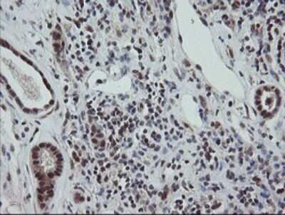 Immunohistochemistry: ERR gamma/NR3B3 Antibody (1E5) [NBP2-45698] - Analysis of Carcinoma of Human kidney tissue.