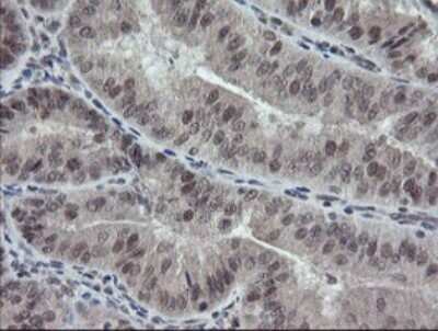 Immunohistochemistry: ERR gamma/NR3B3 Antibody (1E5) [NBP2-45698] - Analysis of Adenocarcinoma of Human endometrium tissue.