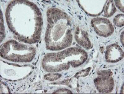 Immunohistochemistry: ERR gamma/NR3B3 Antibody (1E5) [NBP2-45698] - Analysis of Carcinoma of Human prostate tissue.