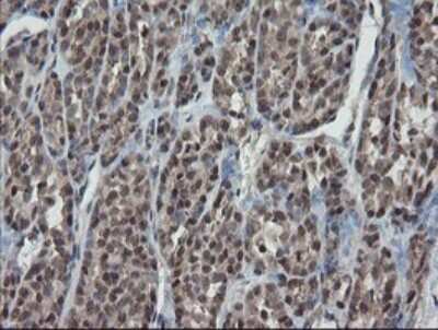 Immunohistochemistry: ERR gamma/NR3B3 Antibody (1E5) [NBP2-45698] - Analysis of Carcinoma of Human thyroid tissue.