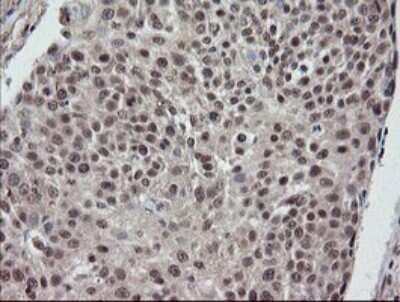 Immunohistochemistry: ERR gamma/NR3B3 Antibody (1E5) [NBP2-45698] - Analysis of Carcinoma of Human bladder tissue.