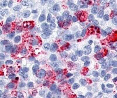 Immunohistochemistry-Paraffin: ERR gamma/NR3B3 Antibody [NLS5960] - Analysis of Breast cancer using this antibody at 9 ug/ ml.