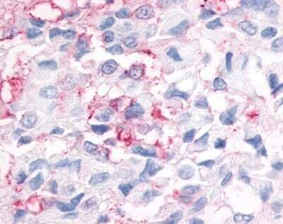 Immunohistochemistry-Paraffin: ERR gamma/NR3B3 Antibody [NLS2400] - Analysis of anti-ERR Gamma antibody with breast cancer at 34 ug/ ml.