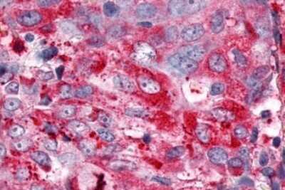 Immunohistochemistry-Paraffin: ERR gamma/NR3B3 Antibody [NLS5960] - Anti-ESRRG / ERR Gamma antibody IHC of human Ovary, Carcinoma. Immunohistochemistry of formalin-fixed, paraffin-embedded tissue after heat-induced antigen retrieval.