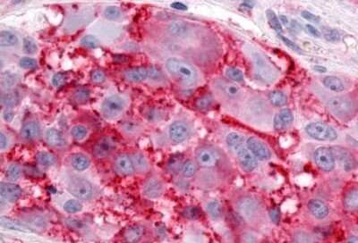 Immunohistochemistry-Paraffin: ERR gamma/NR3B3 Antibody [NLS5960] - Anti-ESRRG / ERR Gamma antibody IHC of human Skin, Melanoma. Immunohistochemistry of formalin-fixed, paraffin-embedded tissue after heat-induced antigen retrieval.