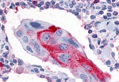 Immunohistochemistry-Paraffin: ERR gamma/NR3B3 Antibody [NLS5960] - Breast, Carcinoma