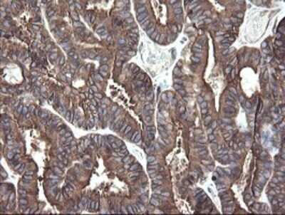 Immunohistochemistry: ERp57/PDIA3 Antibody (OTI4D7) - Azide and BSA Free [NBP2-70849] - Analysis of Adenocarcinoma of Human endometrium tissue. (Heat-induced epitope retrieval by 10mM citric buffer, pH6.0, 120C for 3min)