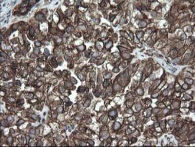 Immunohistochemistry: ERp57/PDIA3 Antibody (OTI4D7) - Azide and BSA Free [NBP2-70849] - Analysis of Adenocarcinoma of Human ovary tissue. (Heat-induced epitope retrieval by 10mM citric buffer, pH6.0, 120C for 3min)