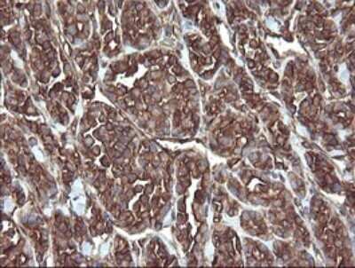 Immunohistochemistry: ERp57/PDIA3 Antibody (OTI4D7) - Azide and BSA Free [NBP2-70849] - Analysis of Carcinoma of Human thyroid tissue. (Heat-induced epitope retrieval by 10mM citric buffer, pH6.0, 120C for 3min)