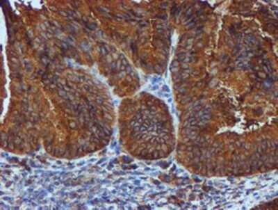 Immunohistochemistry: ERp72 Antibody (OTI2B9) - Azide and BSA Free [NBP2-71488] - Staining of paraffin-embedded Adenocarcinoma of Human endometrium tissue using anti-ERp72 mouse monoclonal antibody.