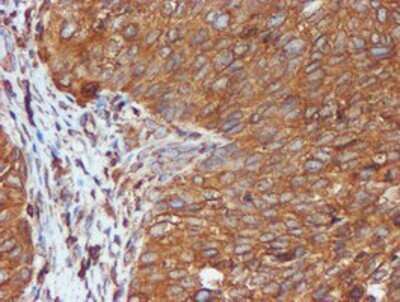 Immunohistochemistry: ERp72 Antibody (OTI2B9) - Azide and BSA Free [NBP2-71488] - Staining of paraffin-embedded Carcinoma of Human bladder tissue using anti-ERp72 mouse monoclonal antibody.