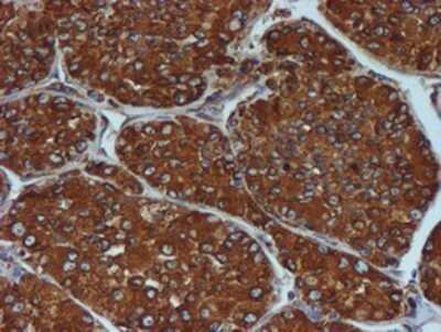 Immunohistochemistry: ERp72 Antibody (OTI2B9) - Azide and BSA Free [NBP2-71488] - Staining of paraffin-embedded Carcinoma of Human liver tissue using anti-ERp72 mouse monoclonal antibody.