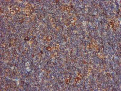 Immunohistochemistry: ERp72 Antibody (OTI2B9) - Azide and BSA Free [NBP2-71488] - Staining of paraffin-embedded Human lymphoma tissue using anti-ERp72 mouse monoclonal antibody.